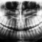 Tooth Replacement Options