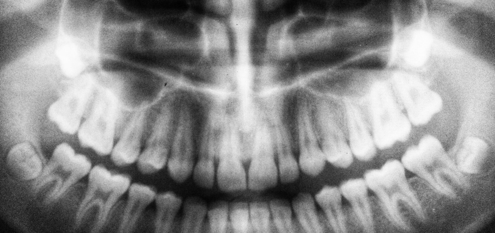 Tooth Replacement Options