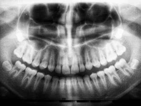 Tooth Replacement Options